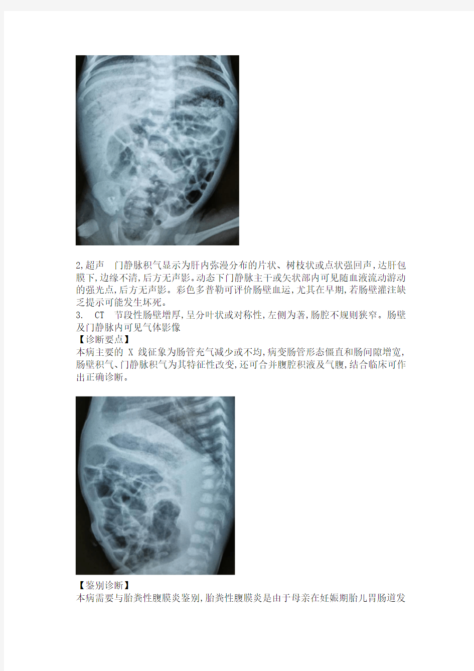 坏死性小肠结肠炎