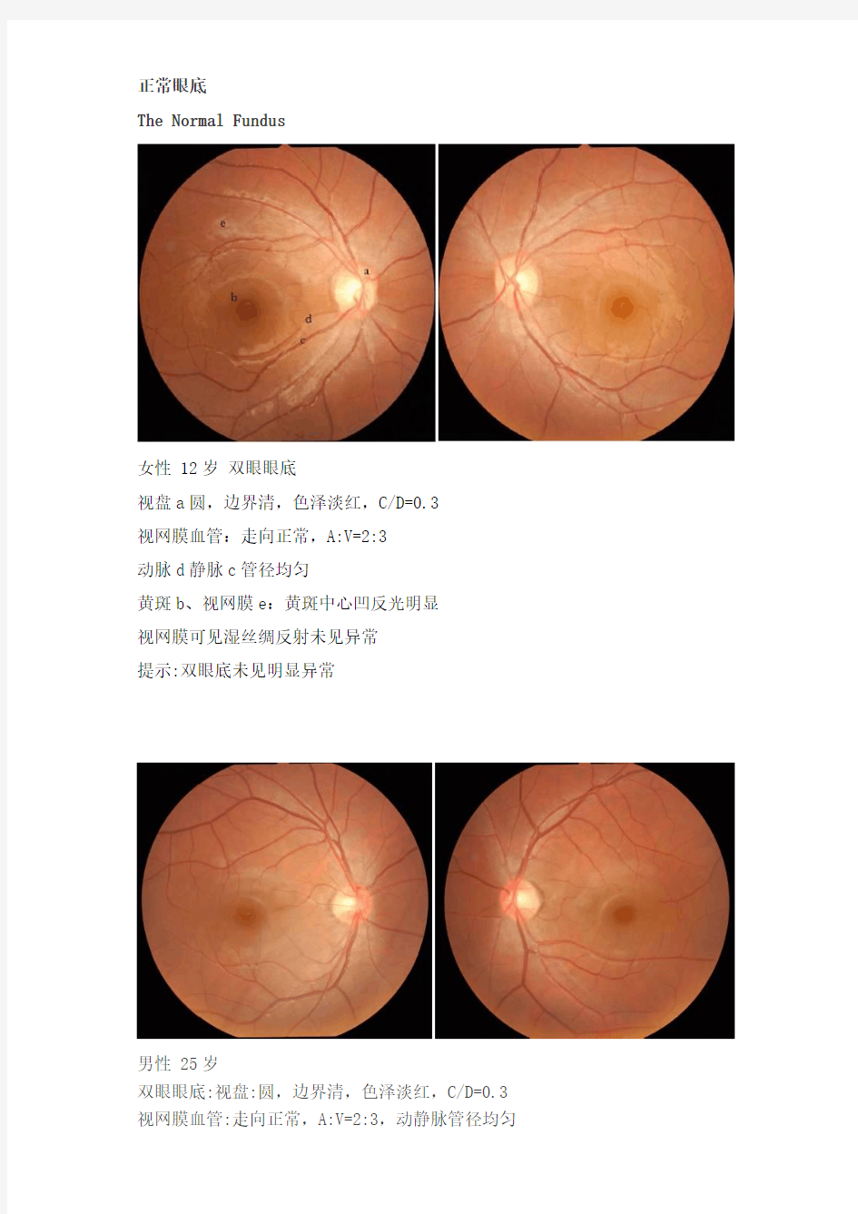 正常眼底及常见异常眼底图分析(眼底照相)