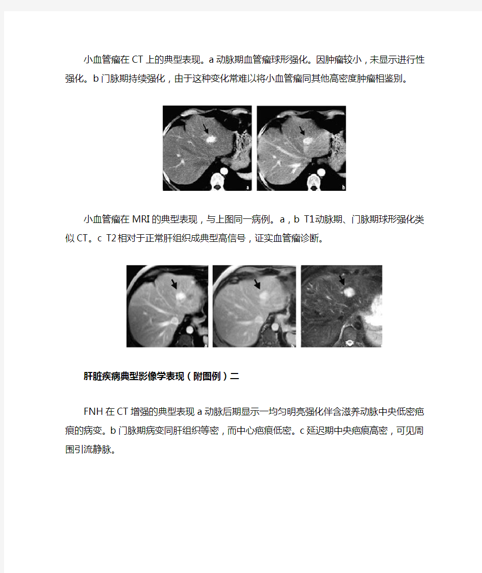 肝脏疾病典型影像学表现(附图例)