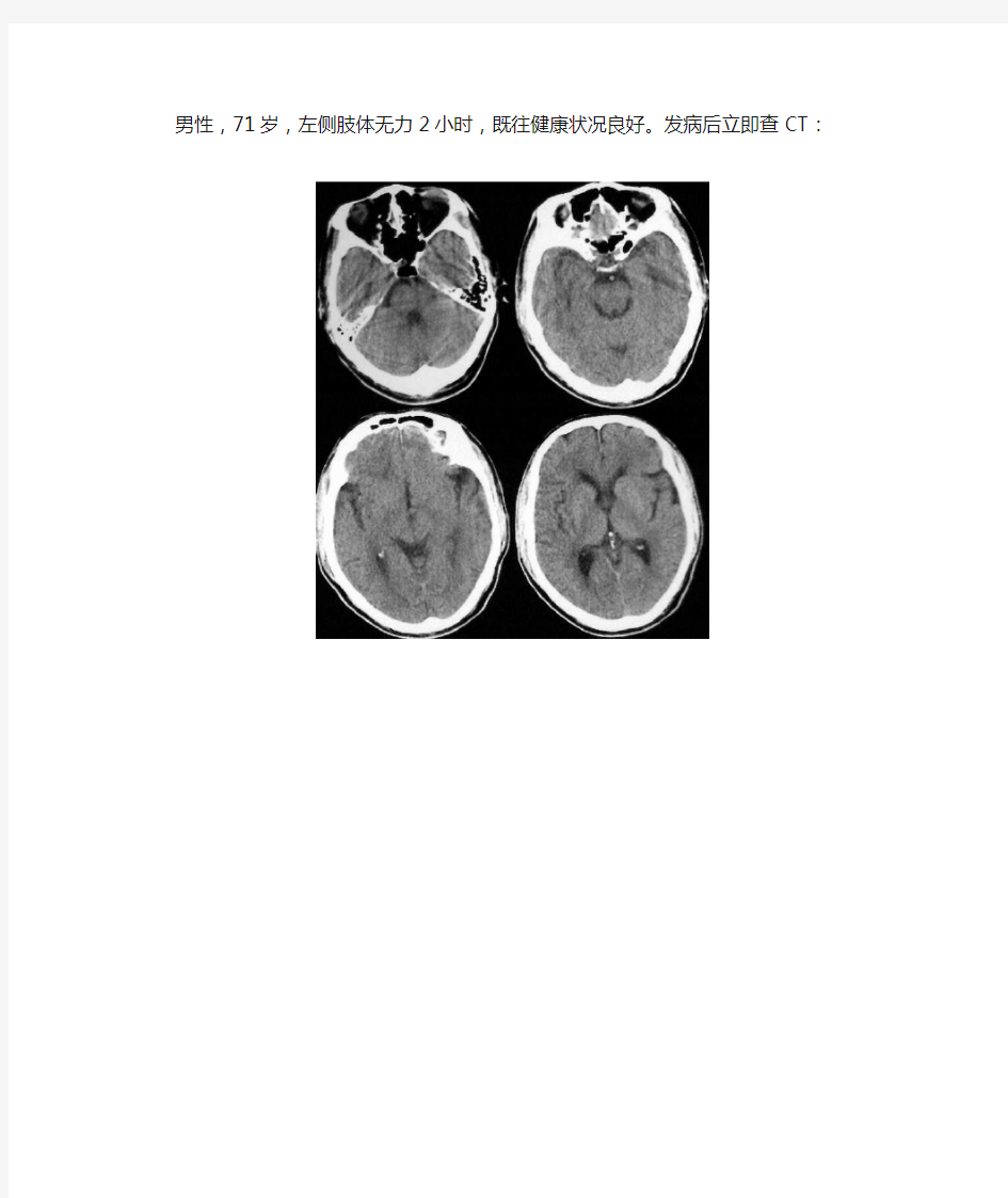 脑梗死超早期CT表现(体现水平的时候到了!!)