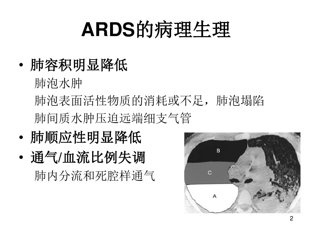 ARDS机械通气要点