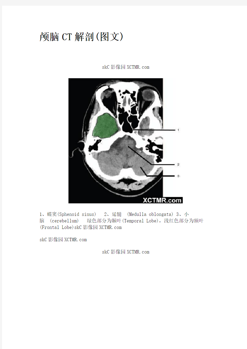 颅脑CT解剖带图解