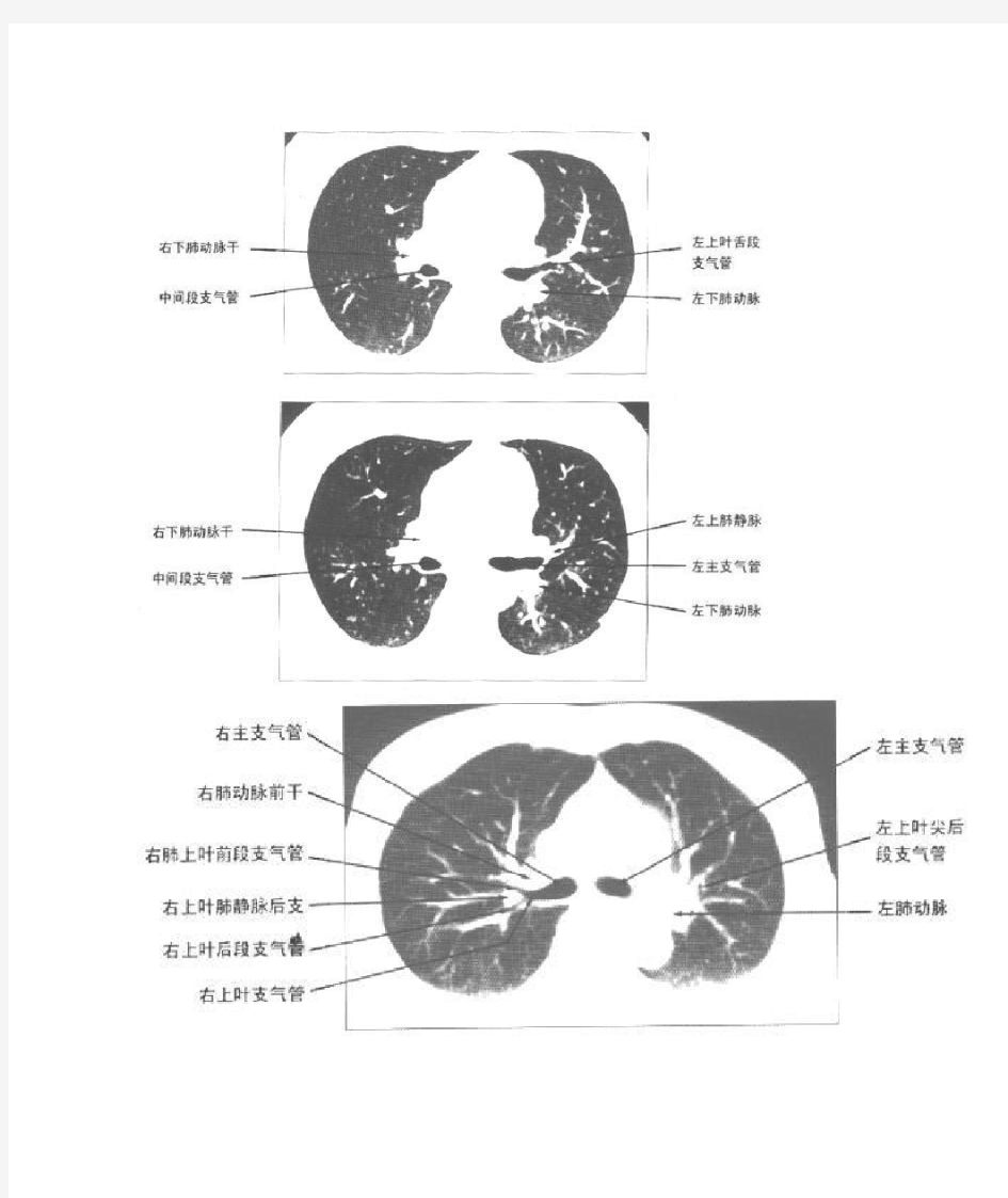 肺分叶分段(整理CT实图及模拟分段图)