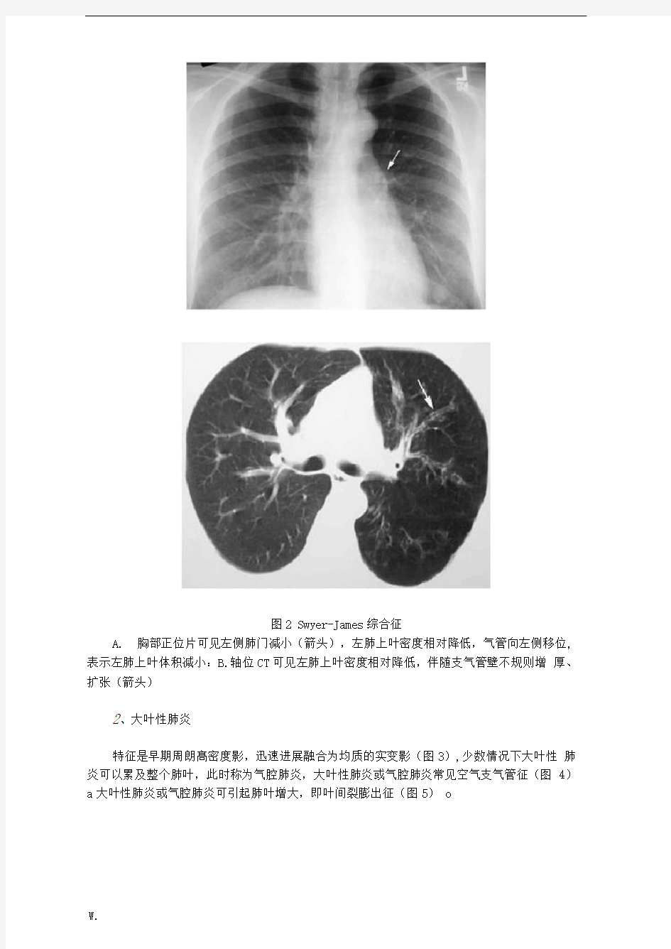 5种肺部感染的影像学鉴别多图