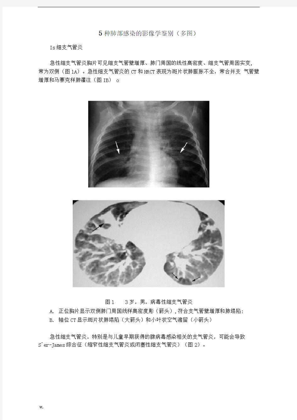 5种肺部感染的影像学鉴别多图