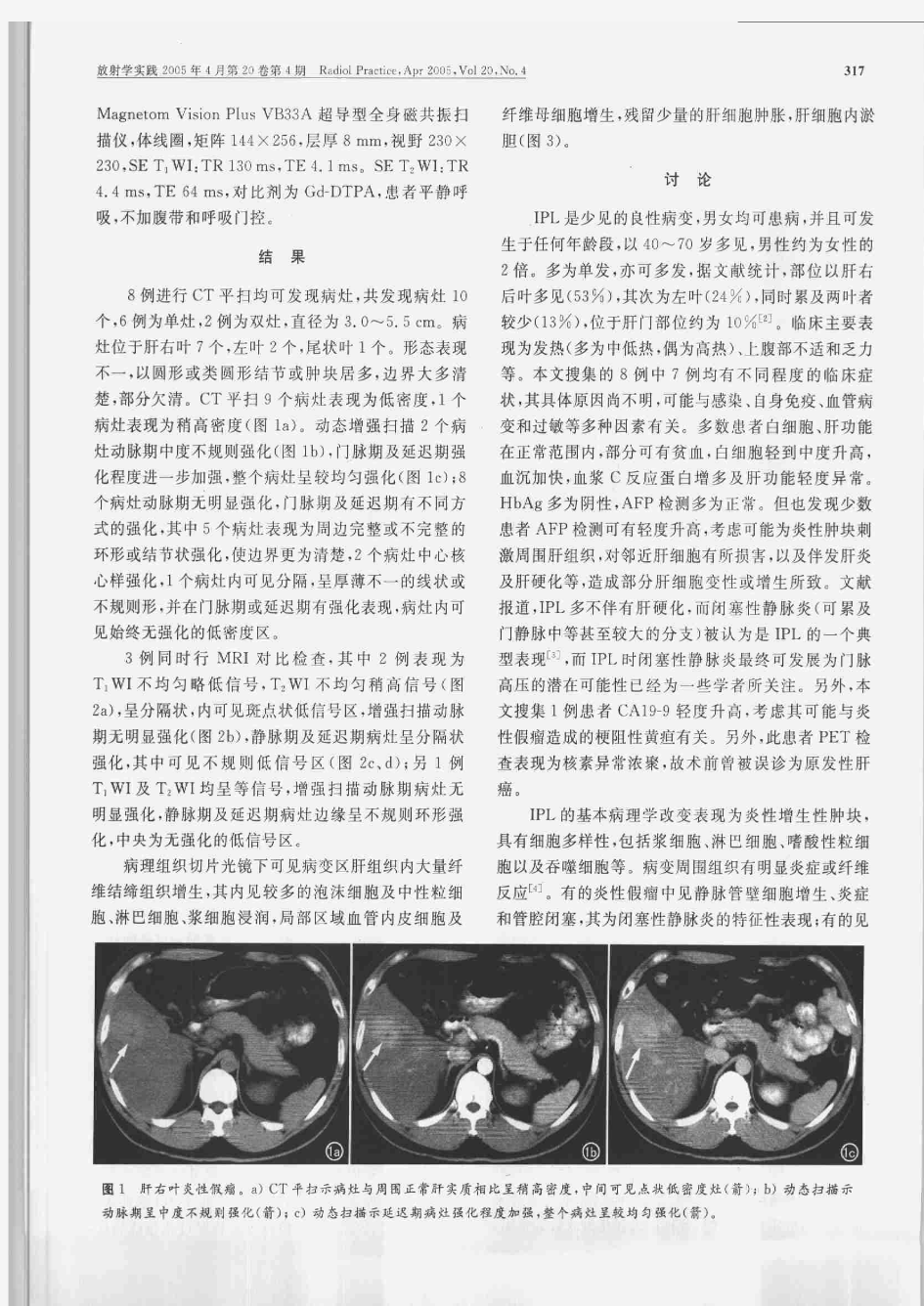 肝脏炎性假瘤的CT及MRI征象