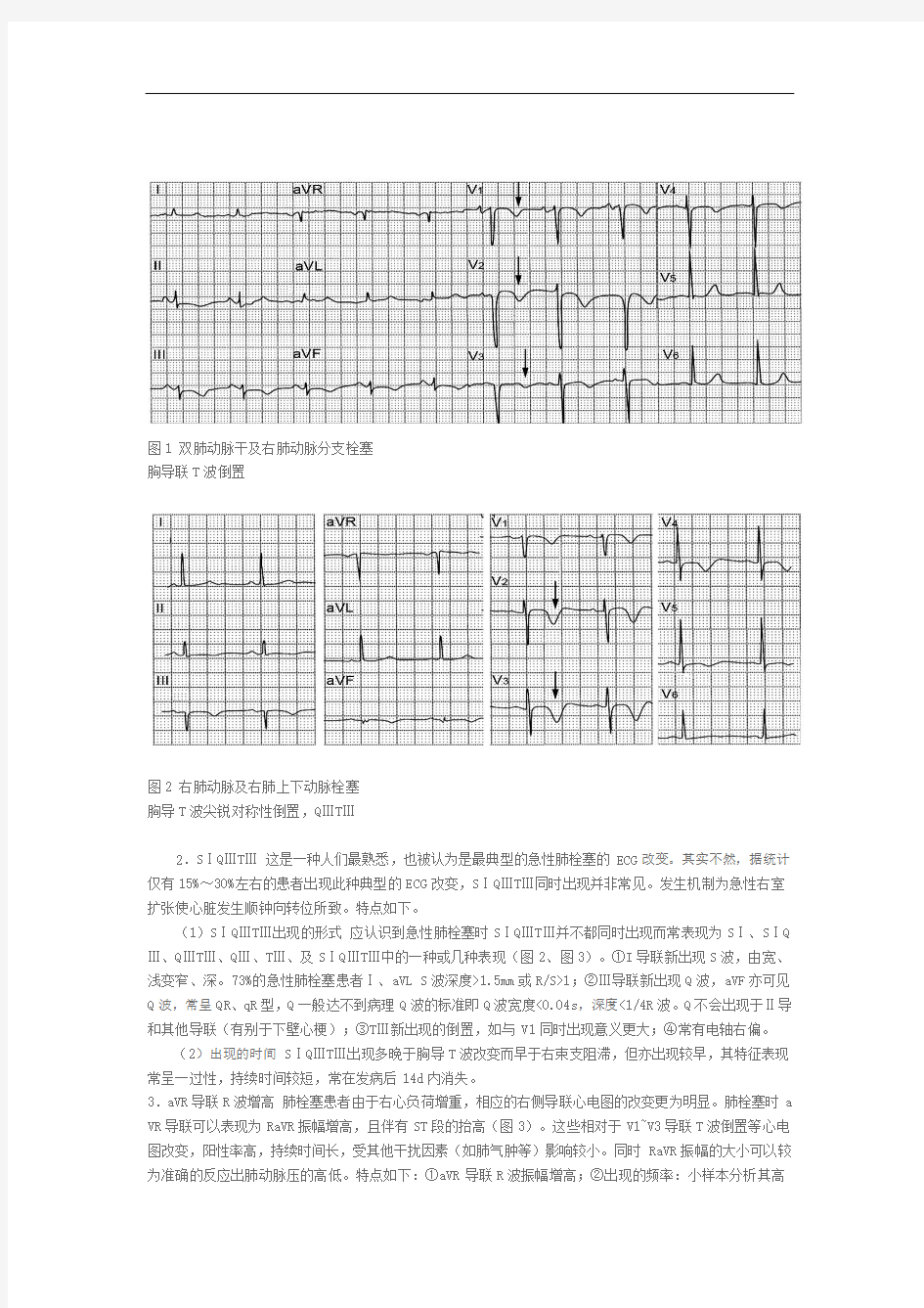 急性肺栓塞的心电图改变