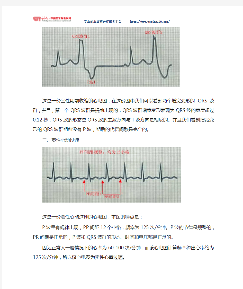 几种常见心血管病的心电图特征