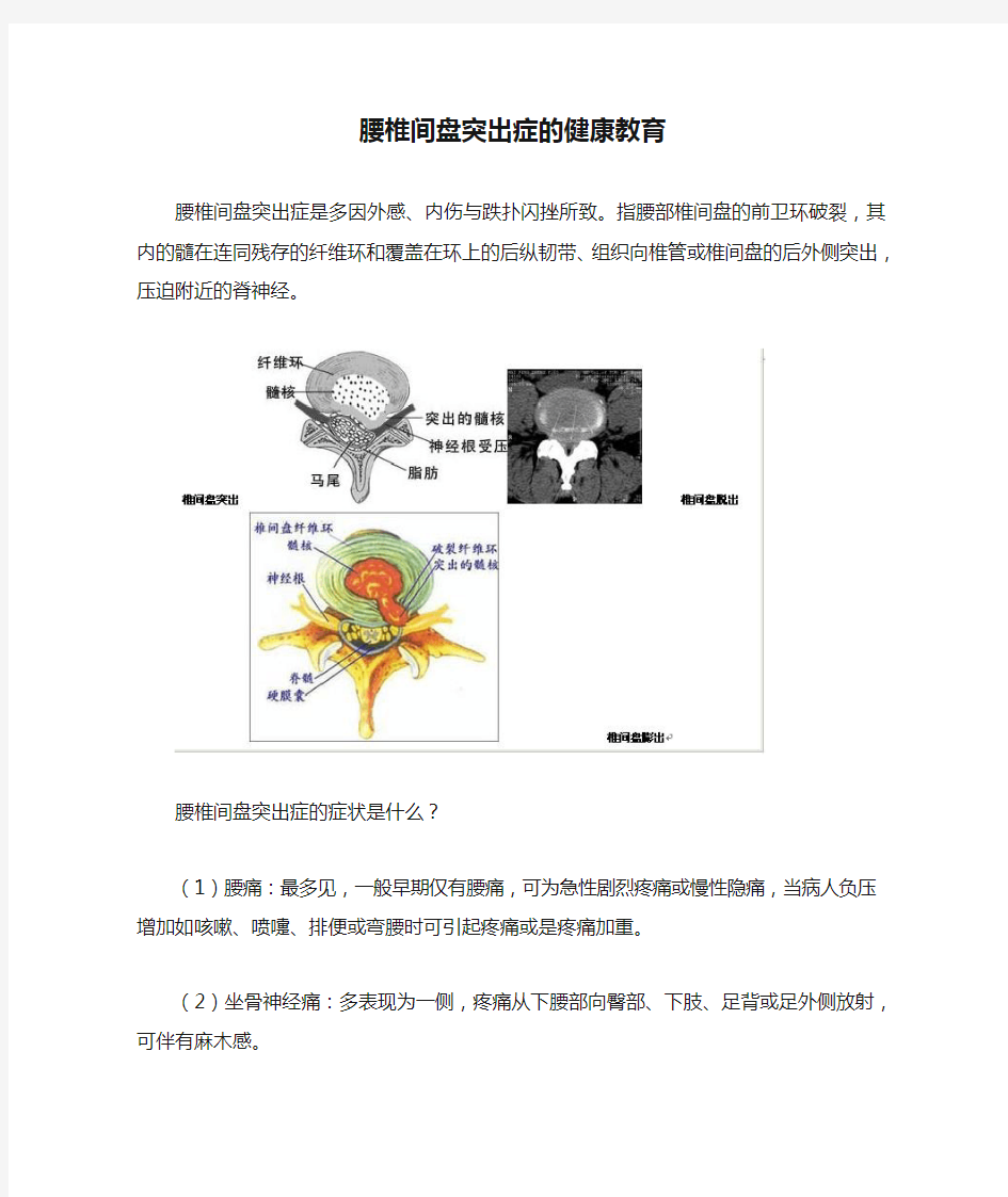 腰椎间盘突出症的健康教育1