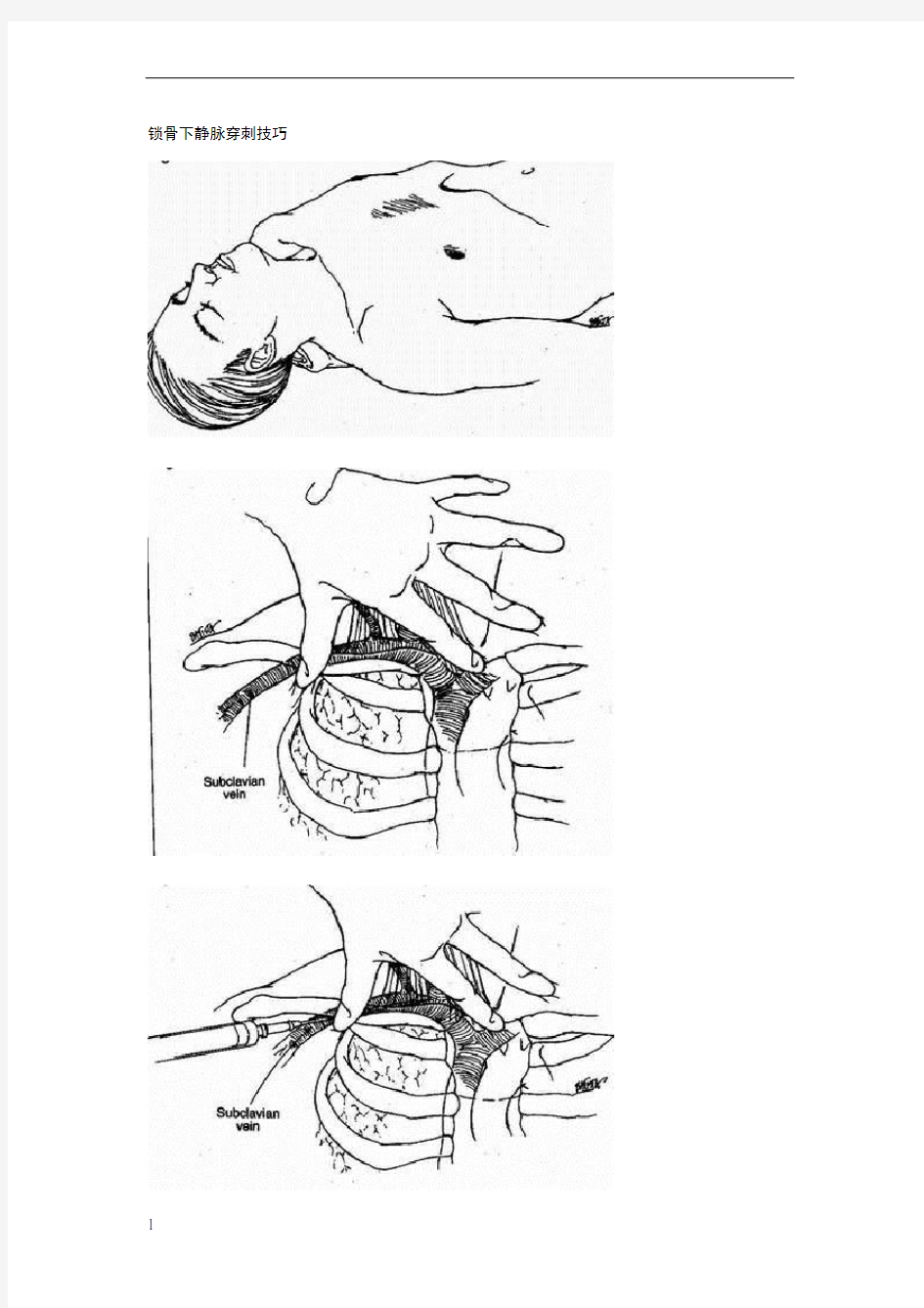 锁骨下静脉穿刺技巧