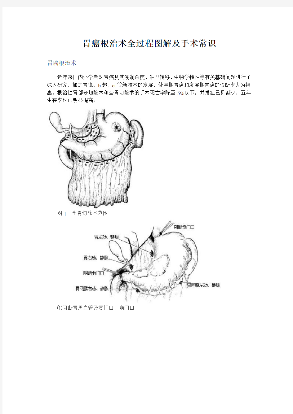 胃癌根治术全过程图解及手术常识1