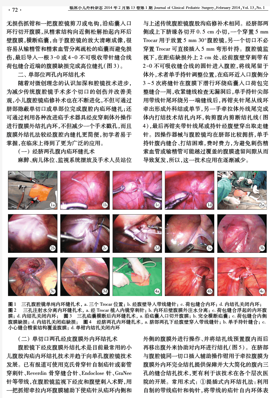 小儿腹腔镜腹股沟疝修补术