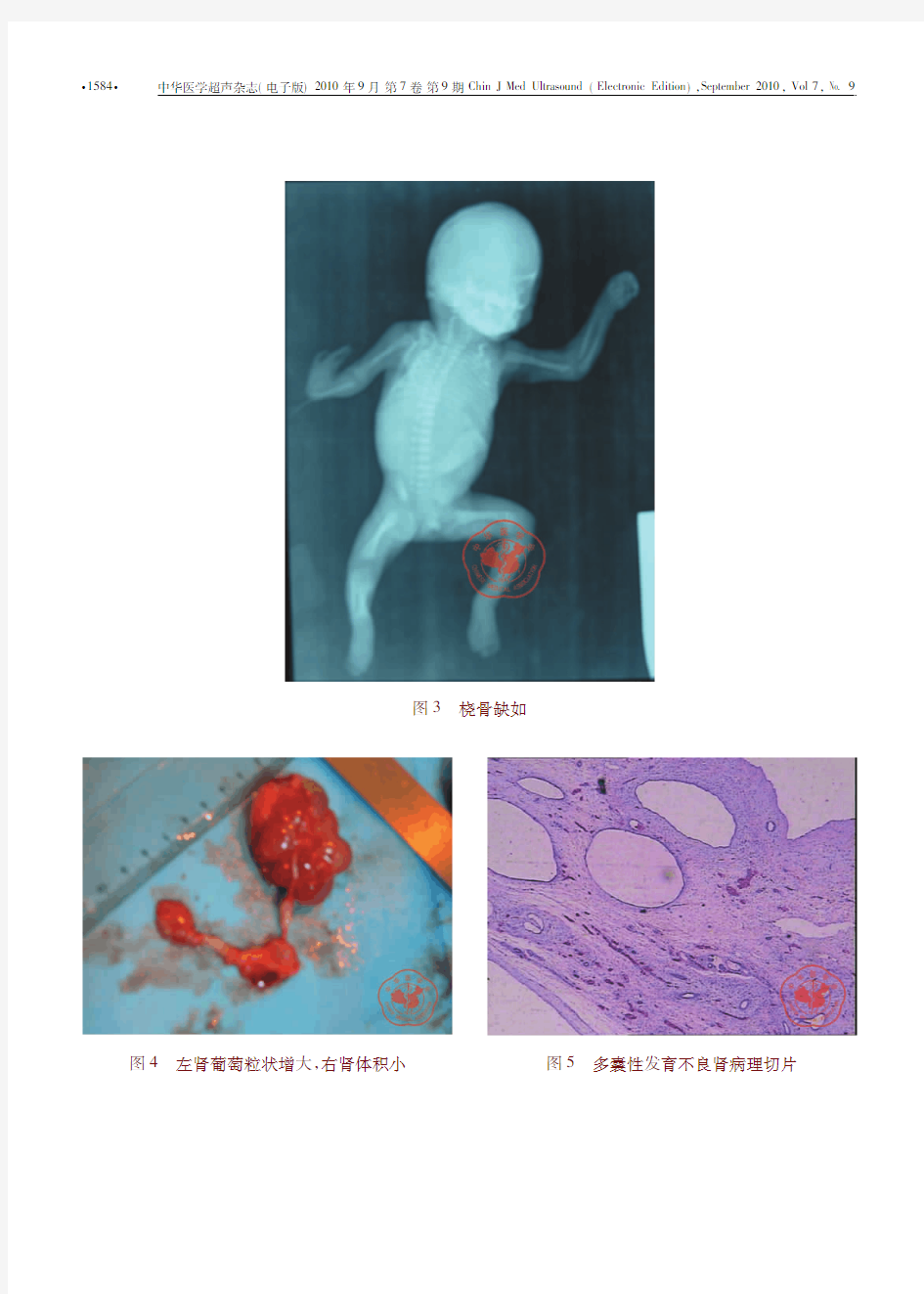 胎儿右桡骨拇指缺如并左侧多囊性发育不良肾超声表现一例
