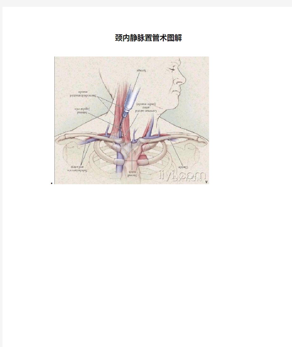 颈内静脉置管术图解
