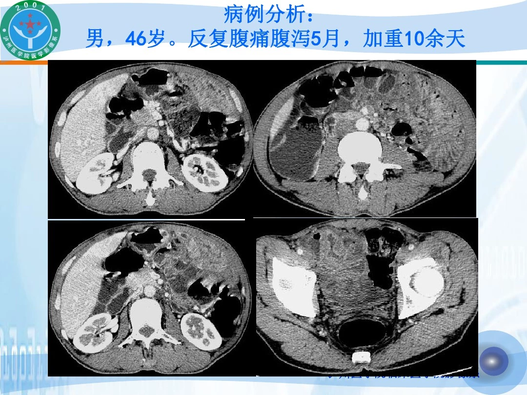 医学影像-缺血性肠病的影像诊断