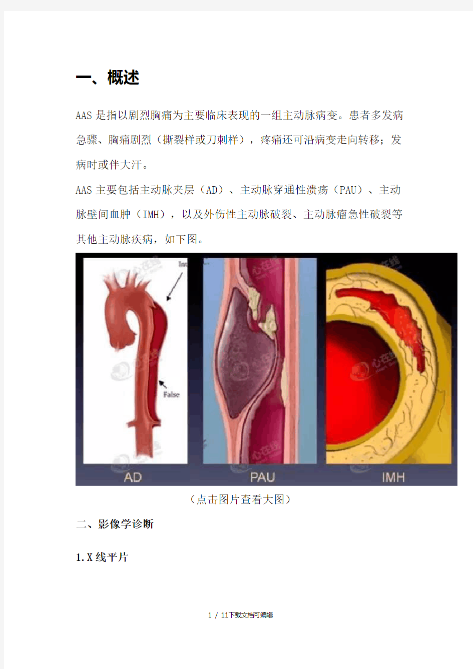 主动脉夹层的影像诊断