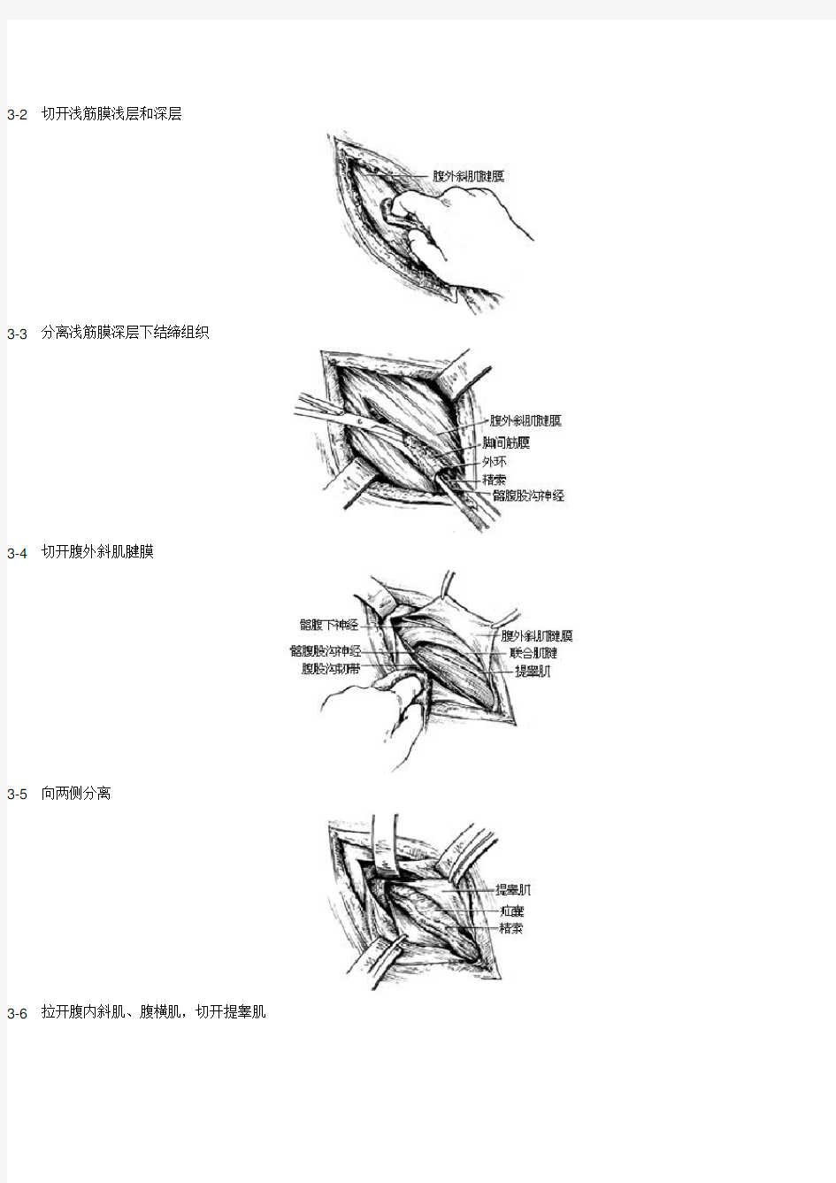 腹股沟斜疝的修补及术式解剖层次