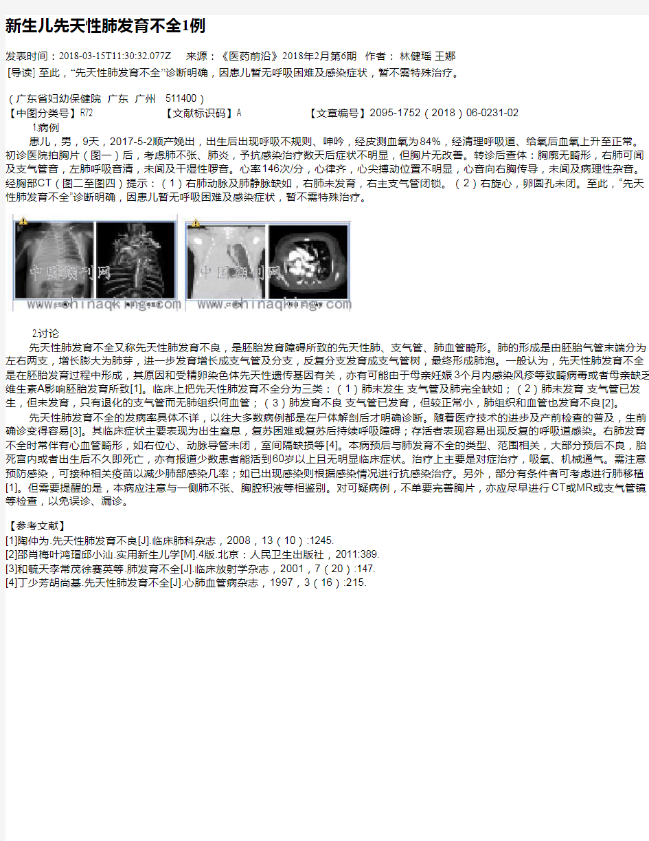 新生儿先天性肺发育不全1例