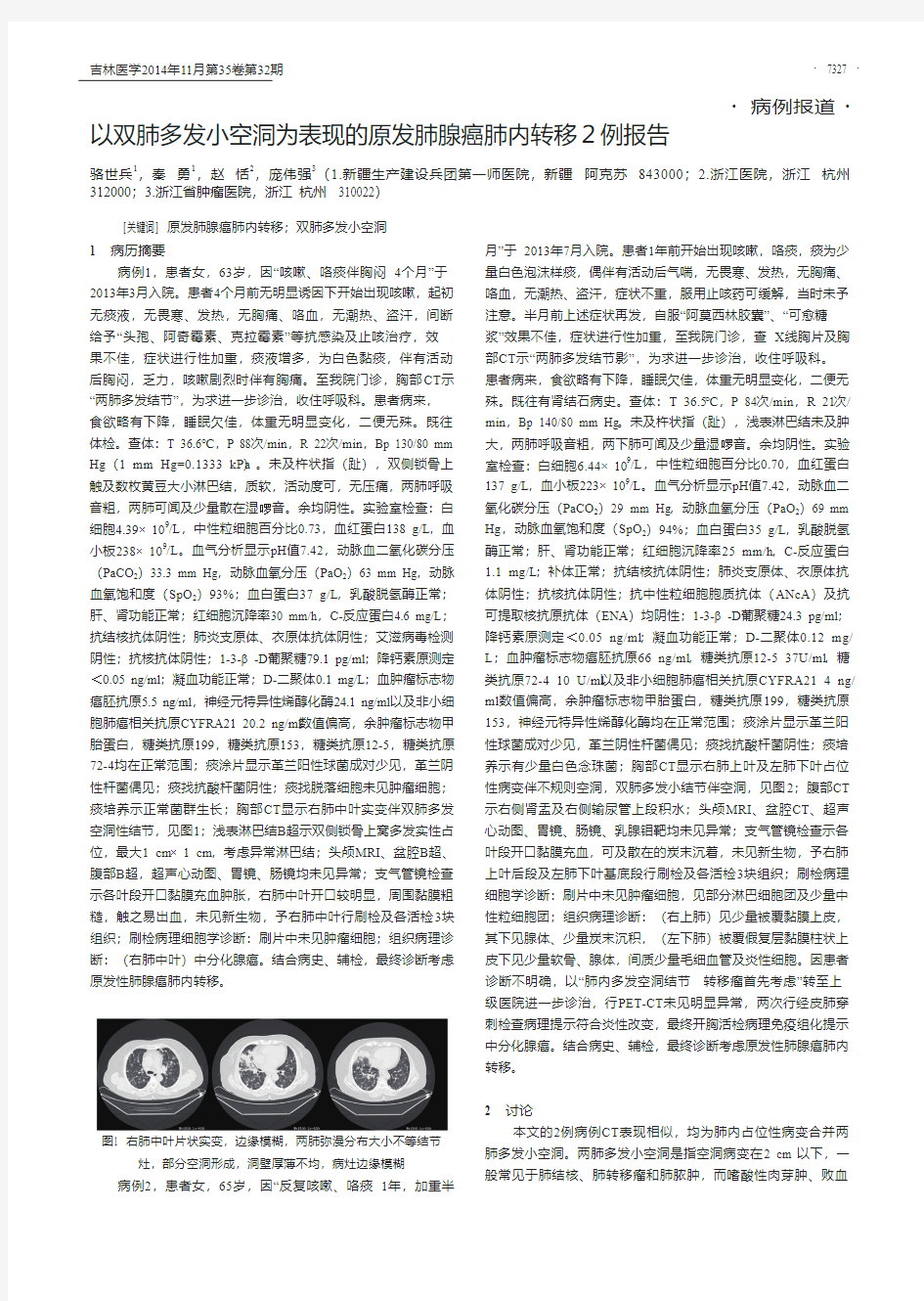 以双肺多发小空洞为表现的原发肺腺癌肺内转移2例报告_骆世兵