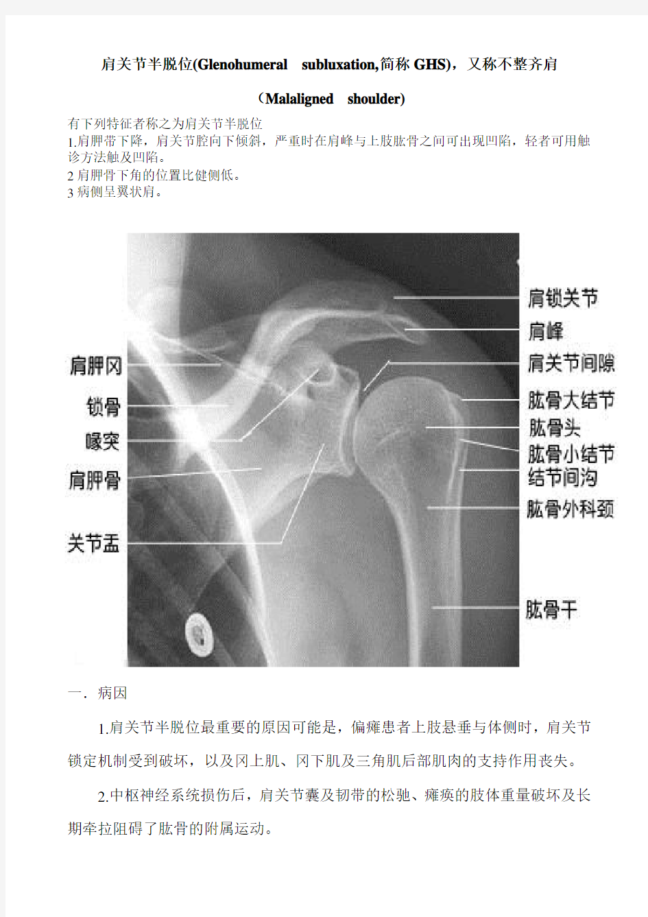 肩关节半脱位(Glenohumeral-subluxation-简称GHS)-又称不-…教学文案