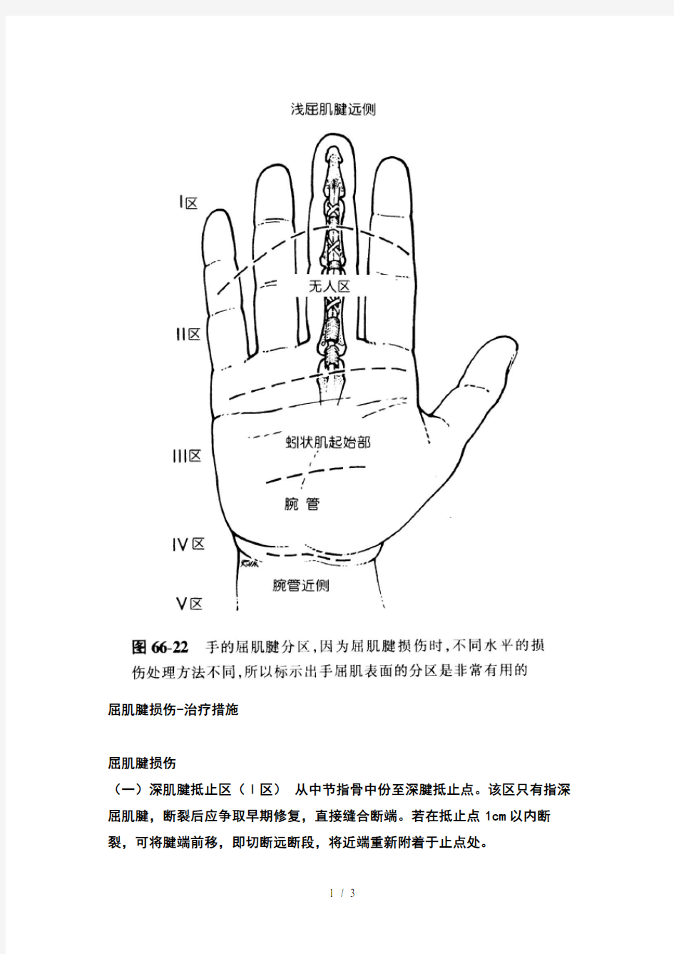 手屈肌腱分区及处理