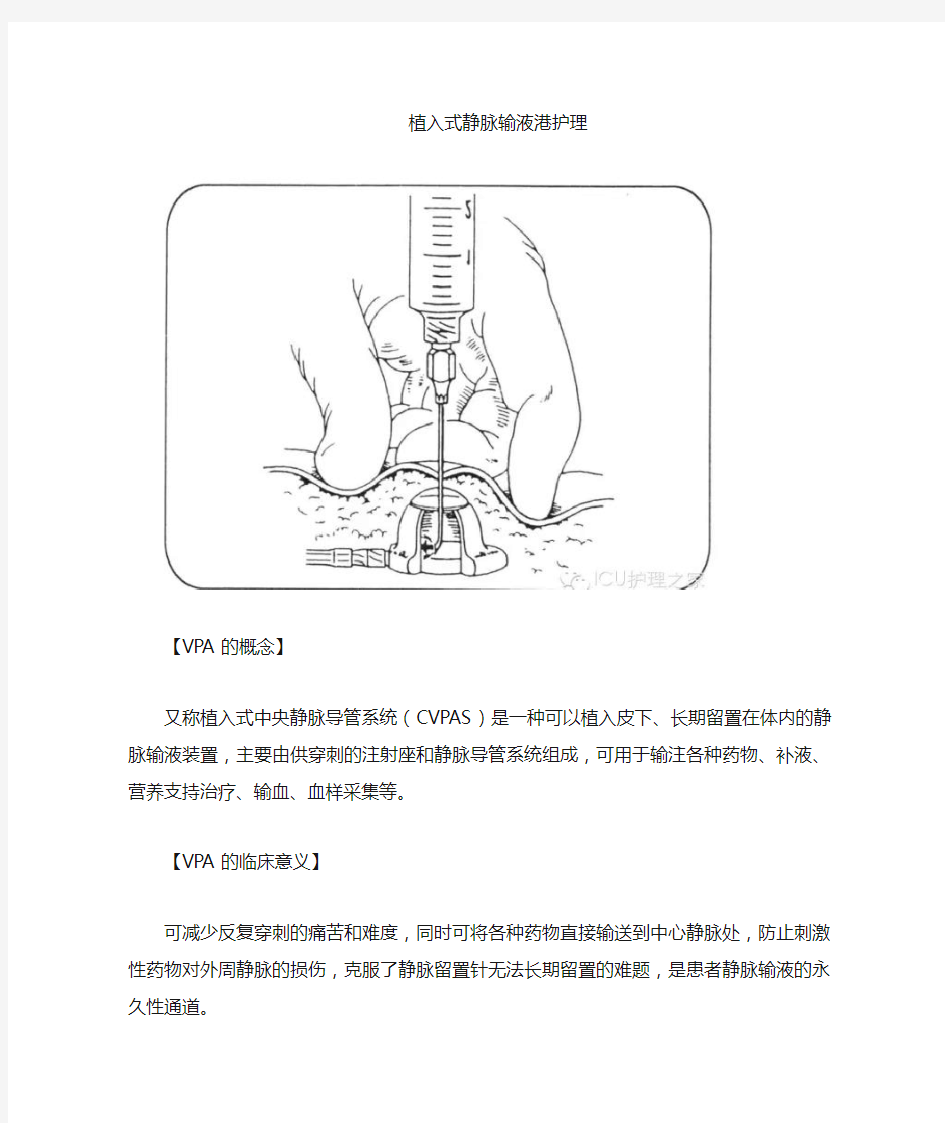 植入式静脉输液港