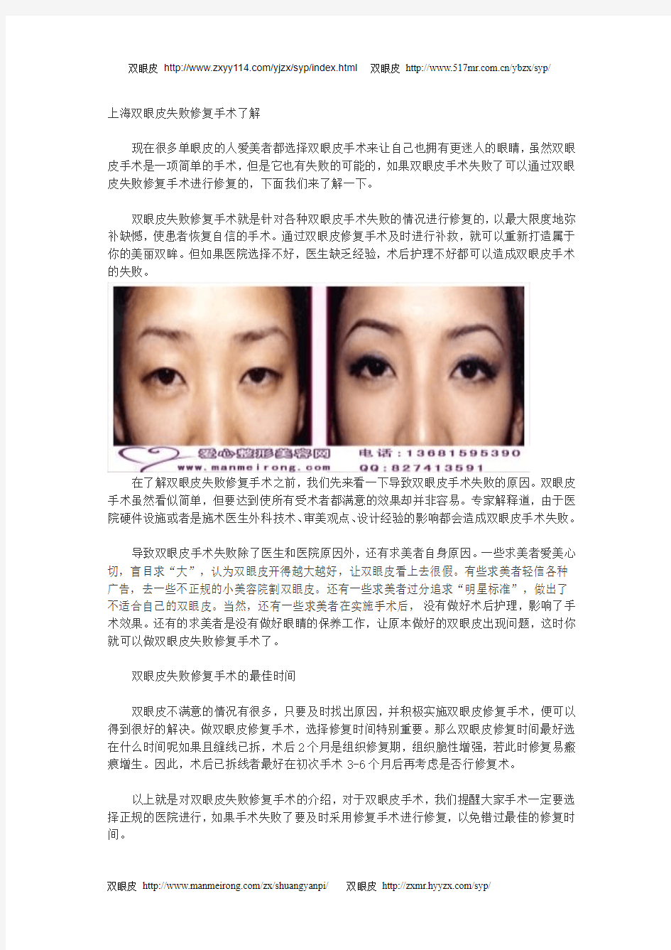 上海双眼皮失败修复手术了解