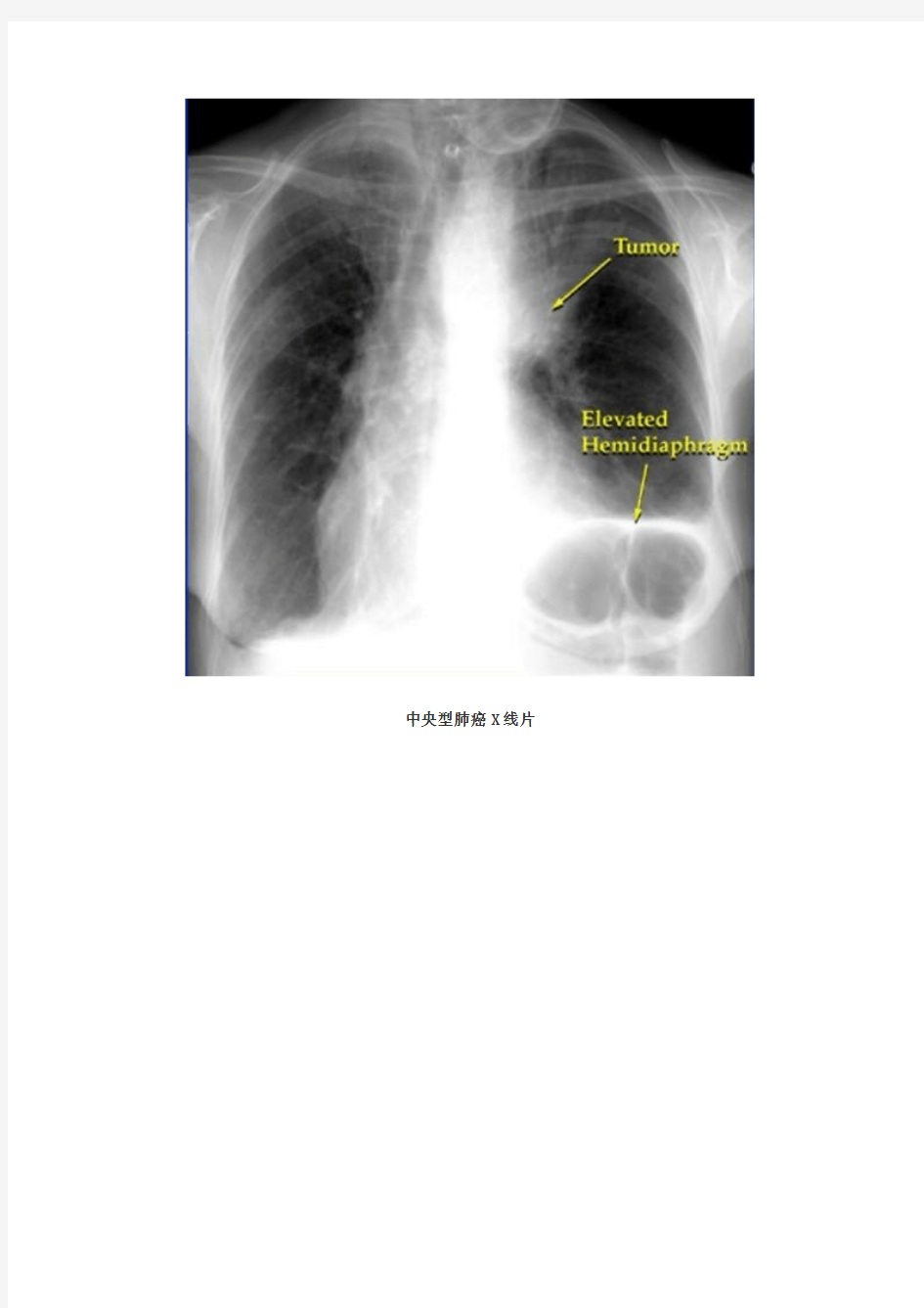 肺癌病人的护理