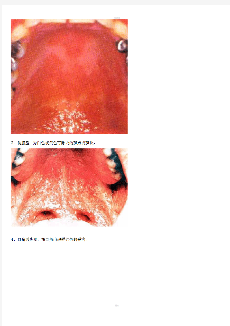 艾滋病的口腔表现图谱