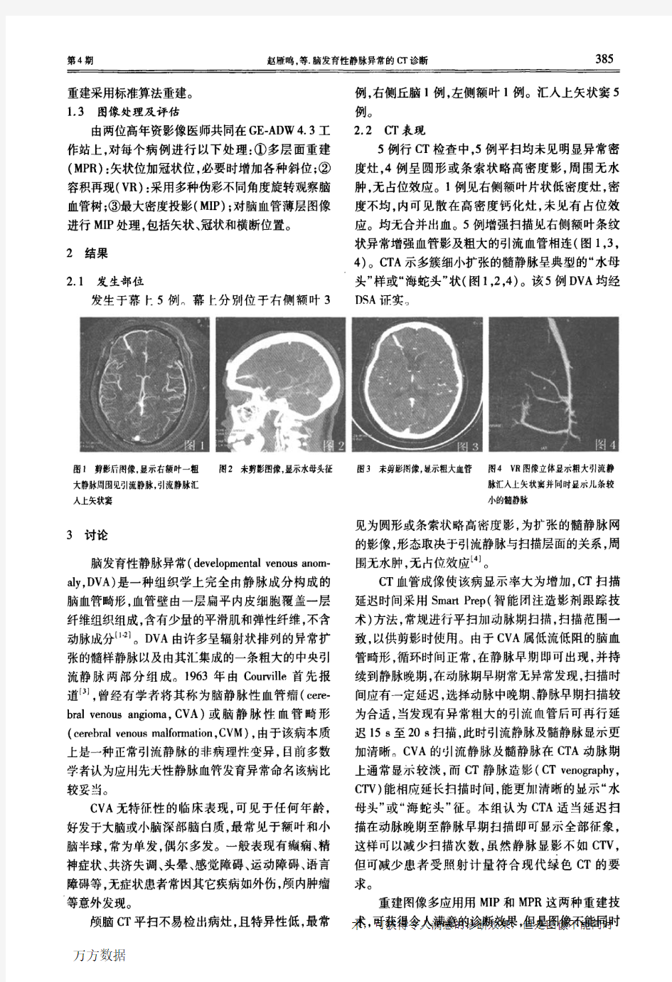 脑发育性静脉异常的CT诊断