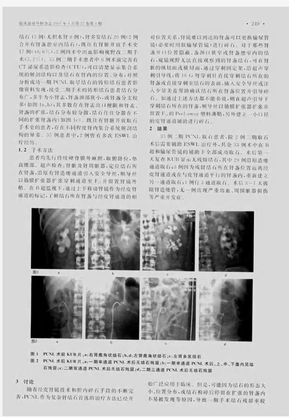 复杂肾结石经皮肾镜取石术后结石残留的原因与处理
