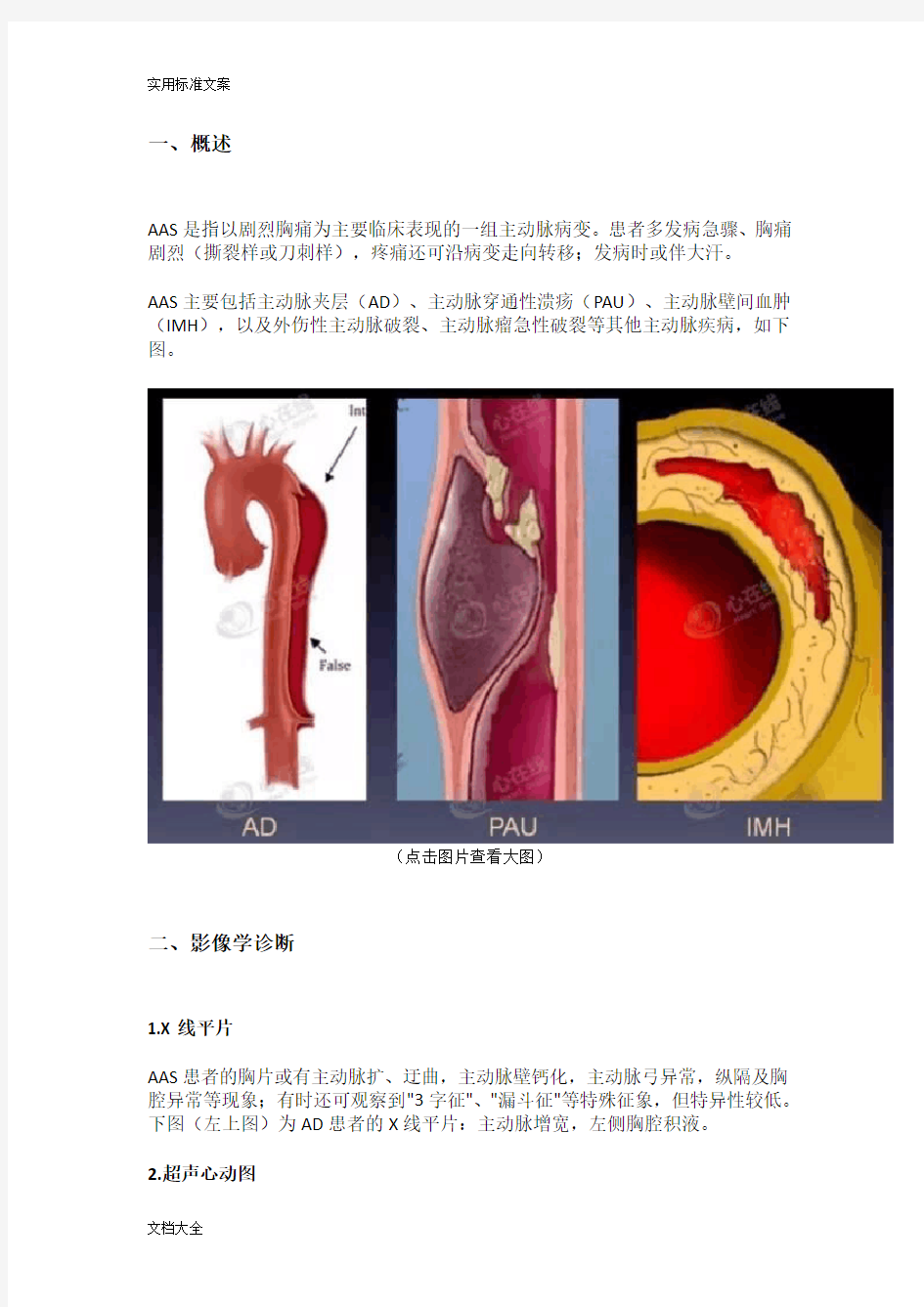 主动脉夹层地影像诊断