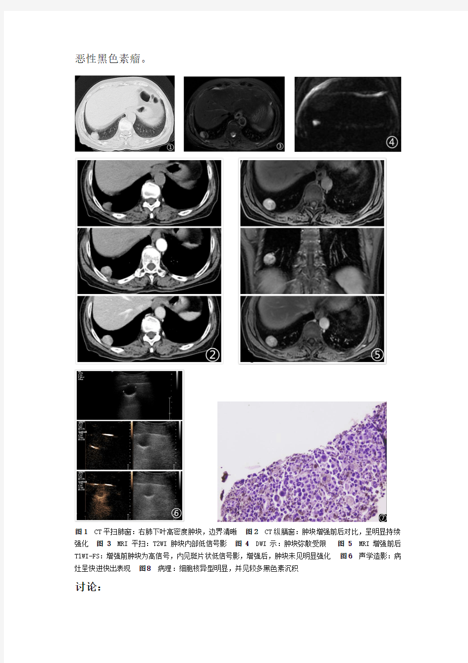 肺原发黑色素瘤一例