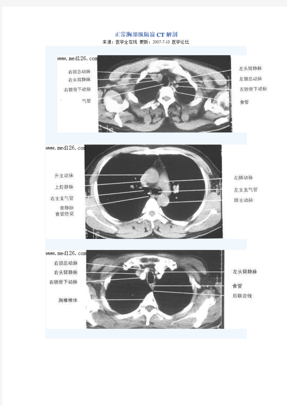 正常胸部纵隔窗CT解剖