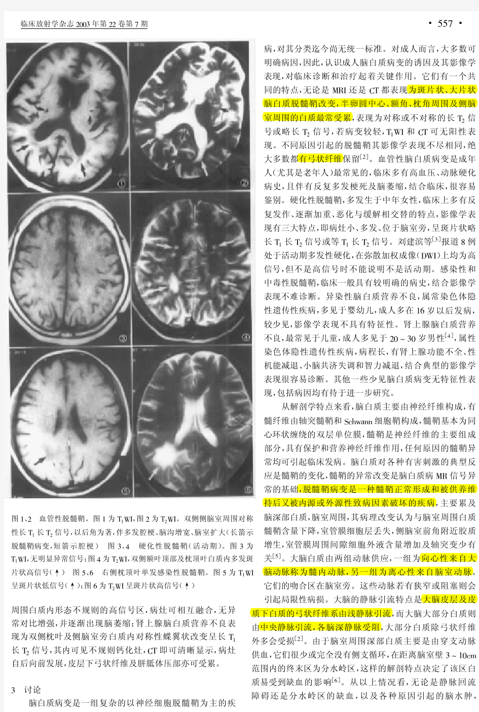 成人脑白质病的CT及MRI诊断