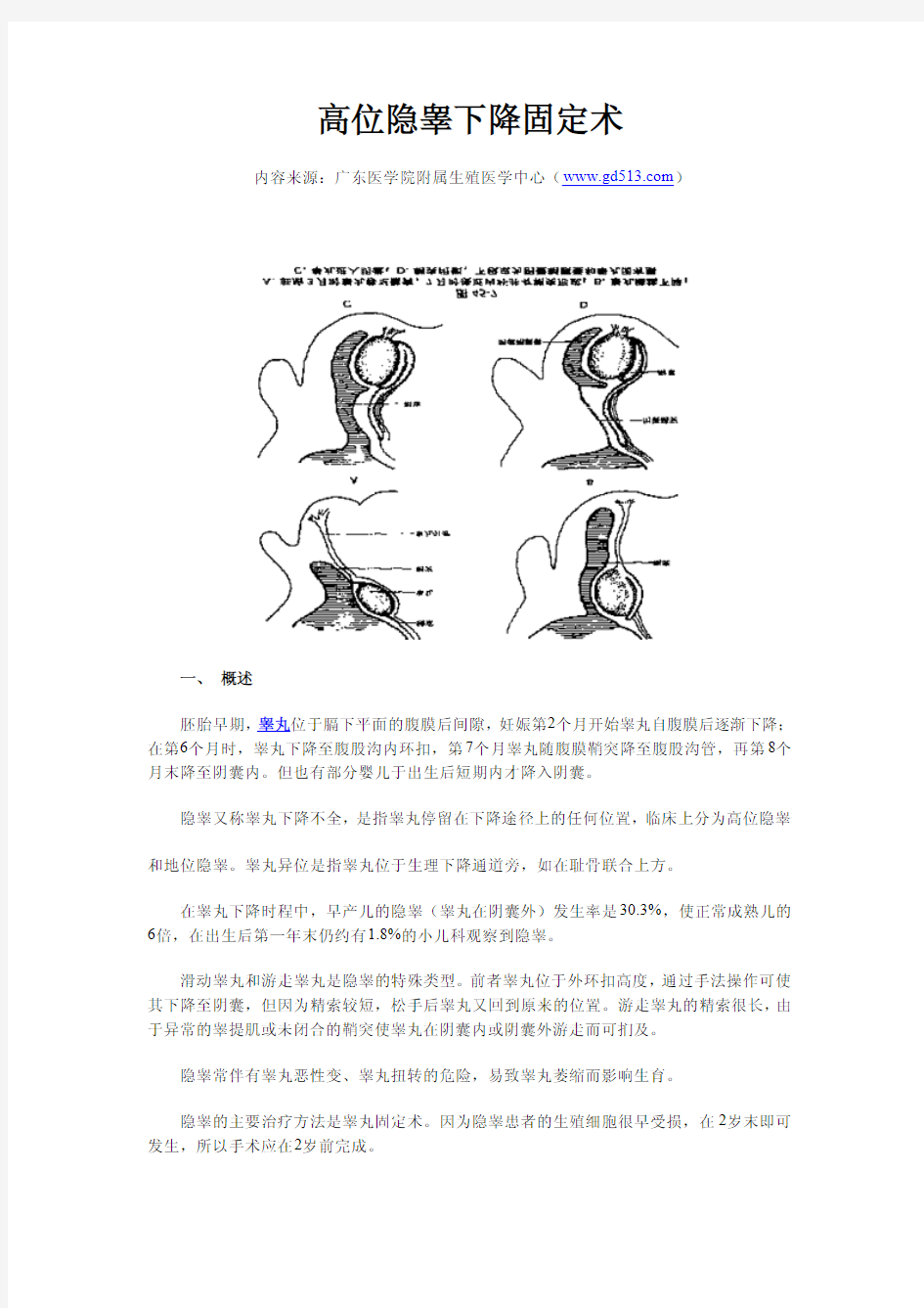 高位隐睾下降固定术