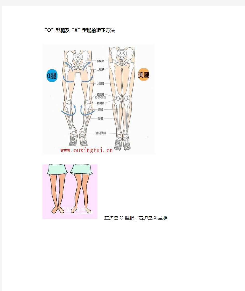 O型腿和X型腿的矫正方法