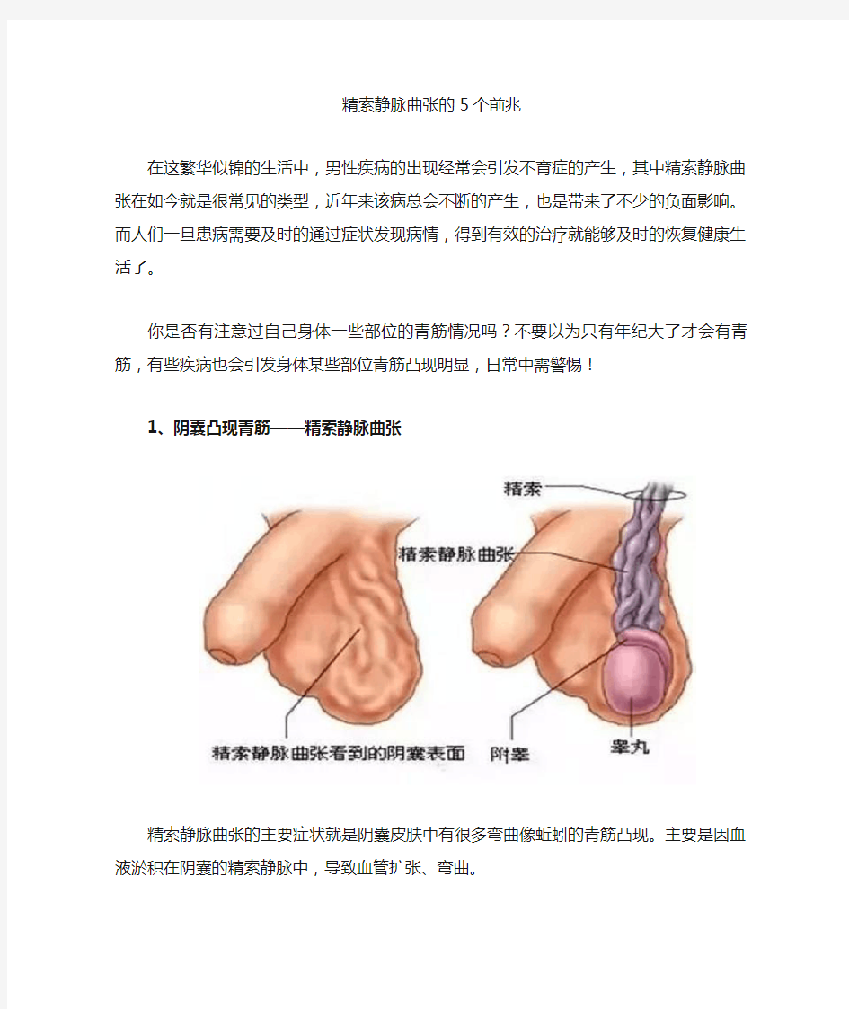 精索静脉曲张的5个前兆