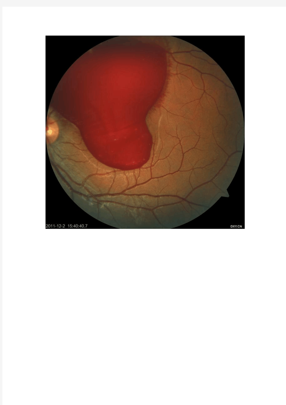 Valsalva视网膜病变