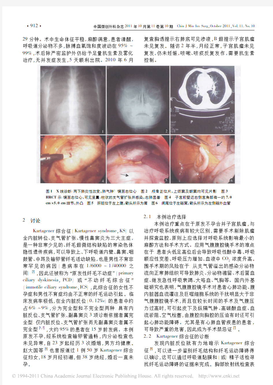 合并Kartagener综合征的非气腹腹腔镜子宫肌瘤剔除术1例及文献复习(2011)中国微创外科杂志(核心)