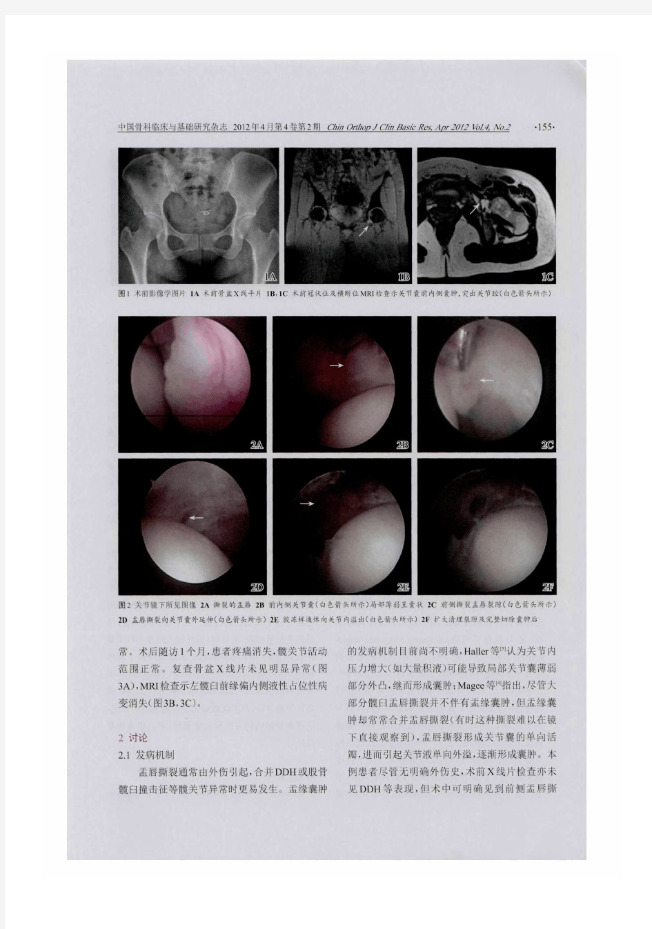 髋臼盂唇撕裂合并前内侧盂缘囊肿的关节镜诊治：一例报告并文献回顾