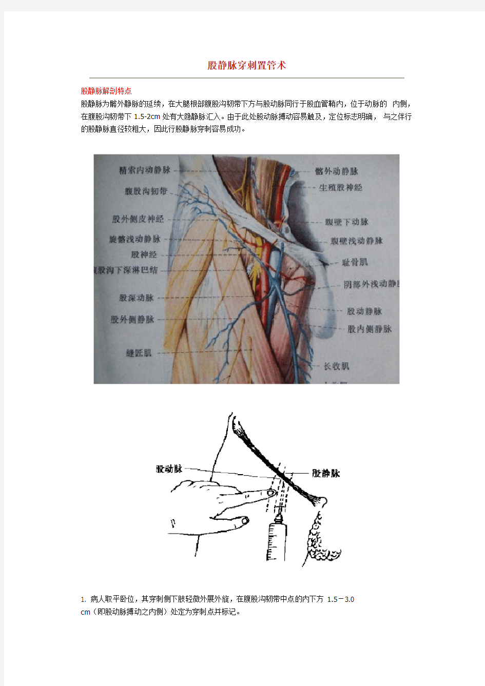 股静脉穿刺置管术