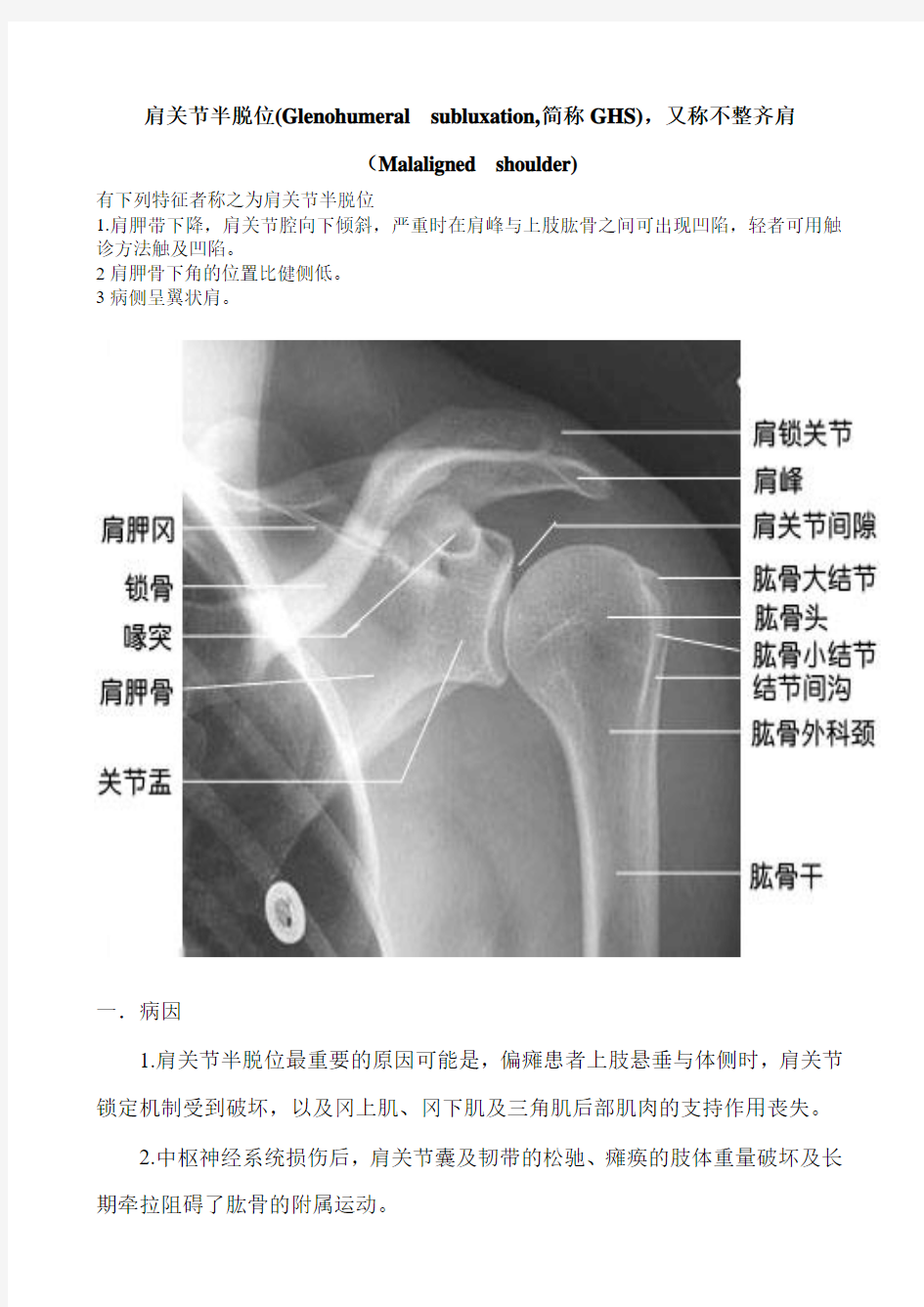 肩关节半脱位(Glenohumeral subluxation,简称GHS),又称不 …