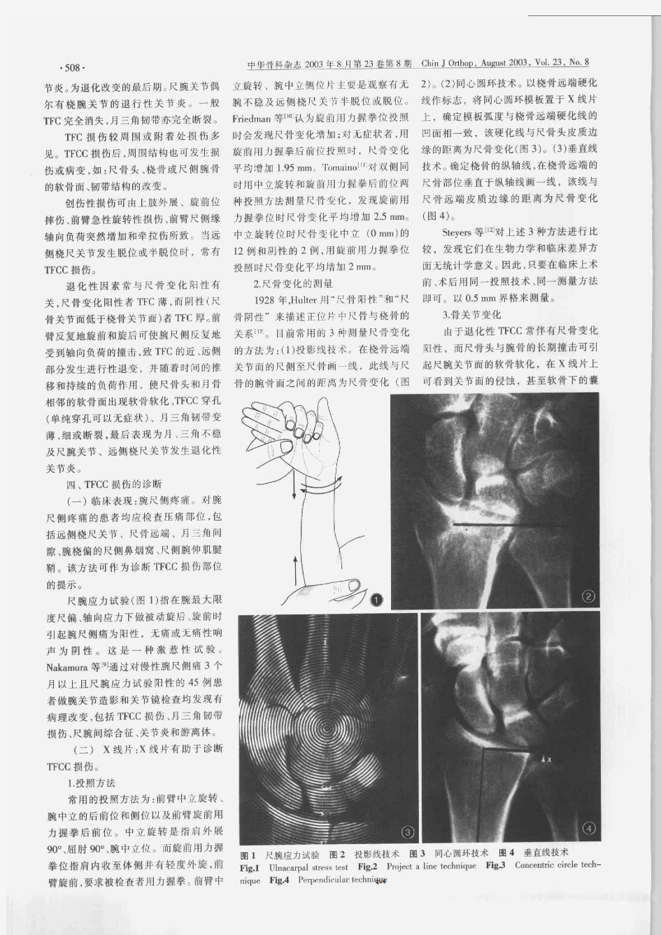 腕关节三角纤维软骨复合体损伤的诊治