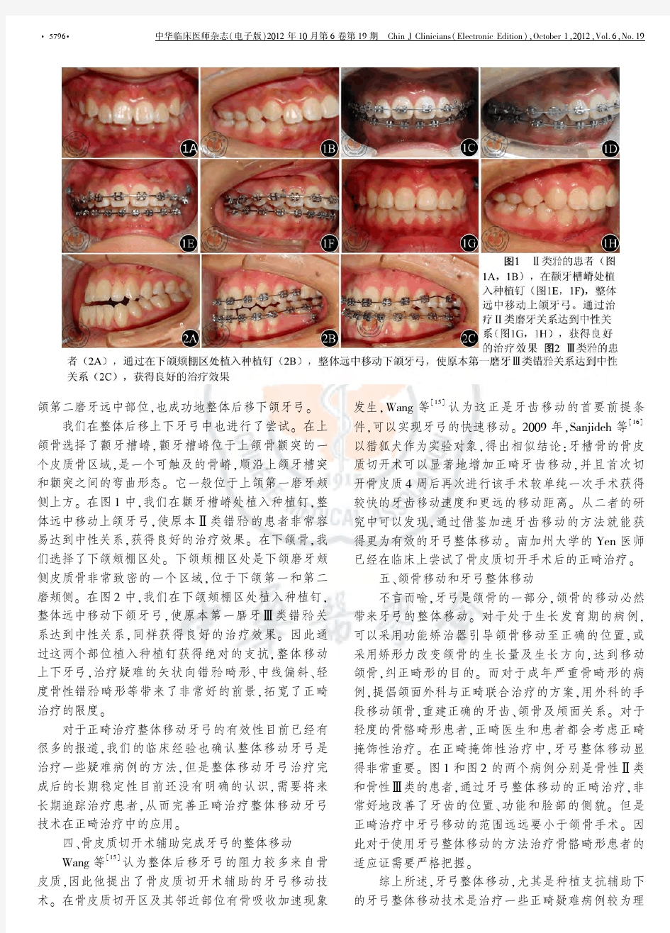 正畸治疗中的牙弓整体移动 - 中华医学会系列杂志 医学专业