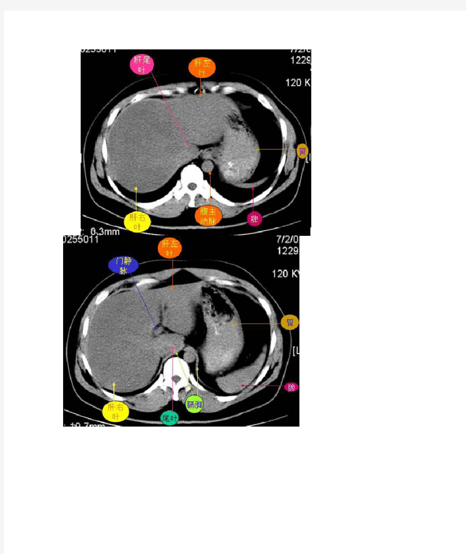腹部CT读片(图)