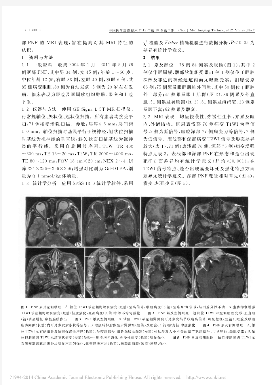眶部丛状神经纤维瘤的MRI表现
