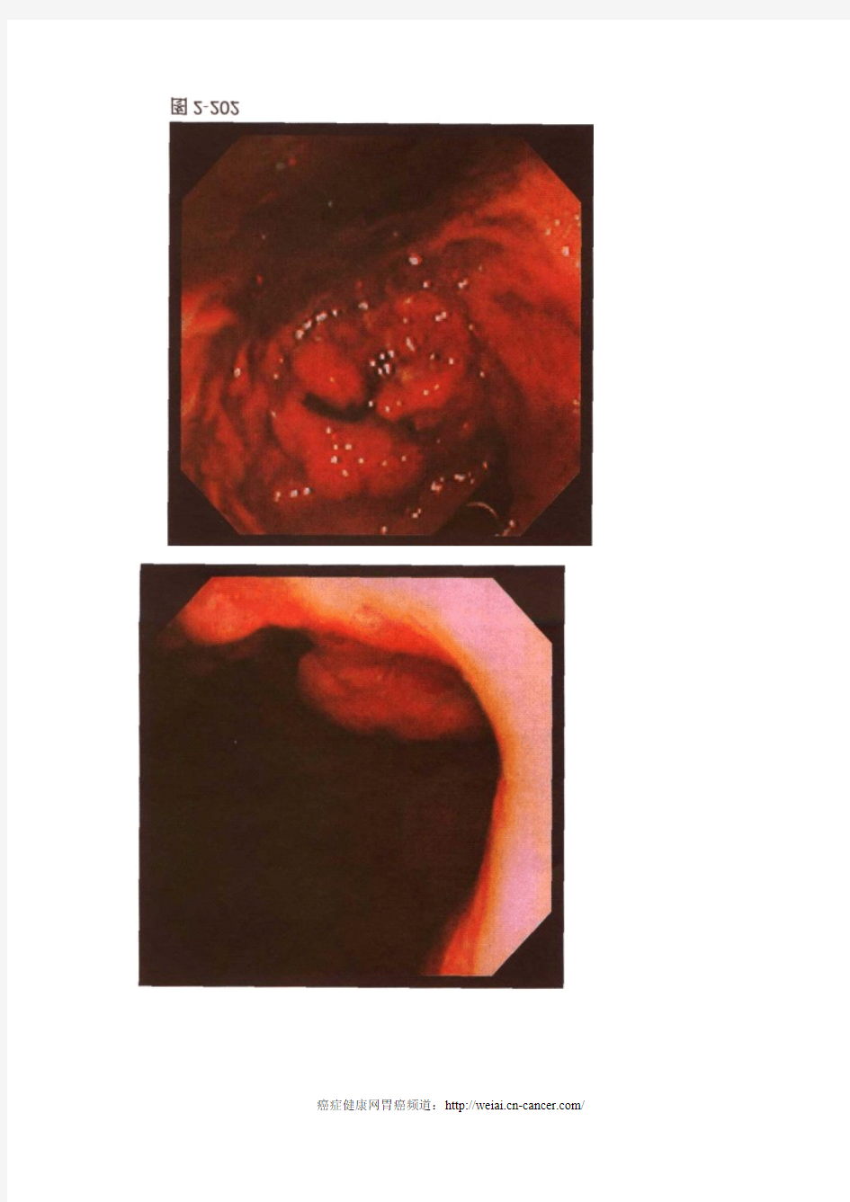 进展期胃癌胃镜图片
