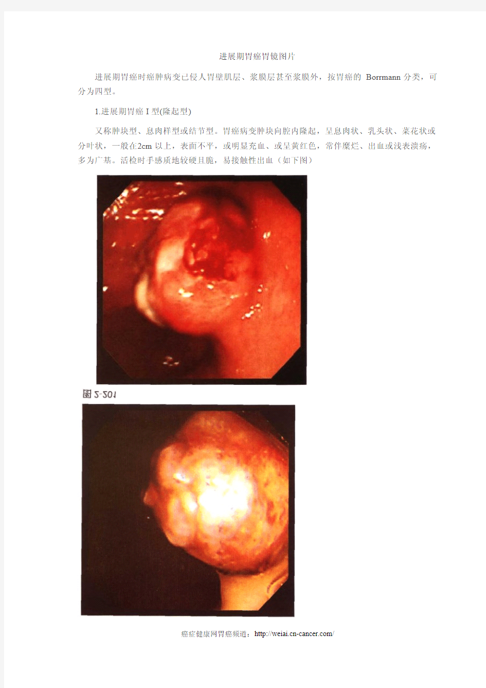 进展期胃癌胃镜图片