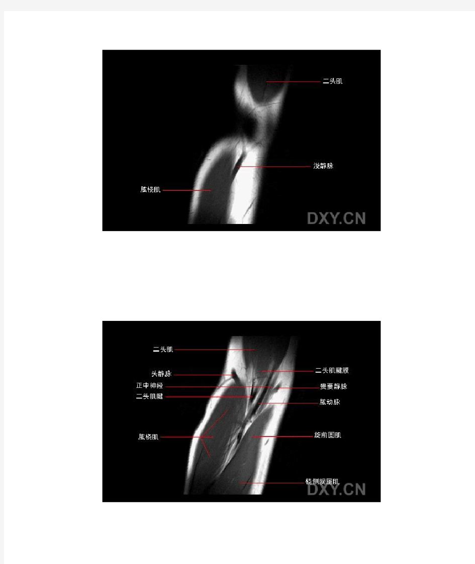 正常肘关节MRI解剖及病变